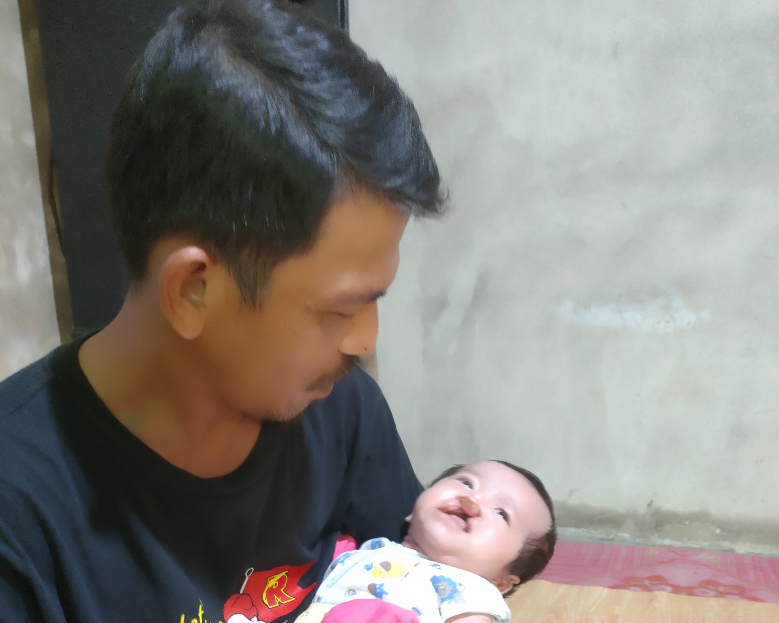 Alami Sumbing, Bantu Bayi 2 Bulan Ini Lakukan Operasi