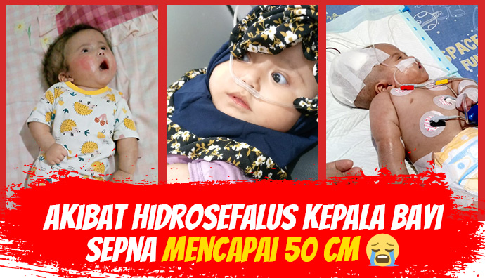Idap Hidrosefalus, Bantu Sepna Bisa Lakukan Pengobatan